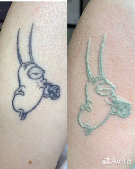 Лазерное удаление татуировки, татуаж, перманент