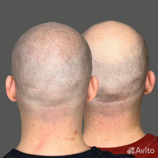 Трихопигментация SMP