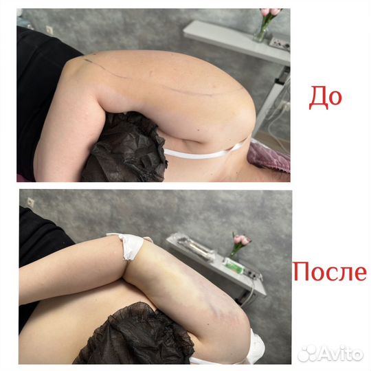 Липосакция рук