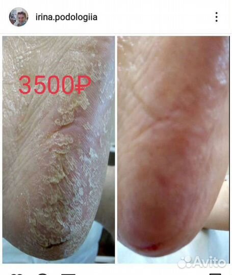 Педикюр гигиенический (медицинский). Выезд на дом