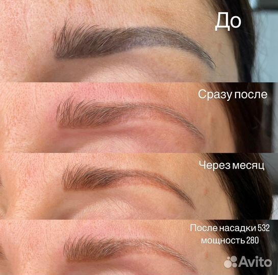 Удаление татуажа лазером