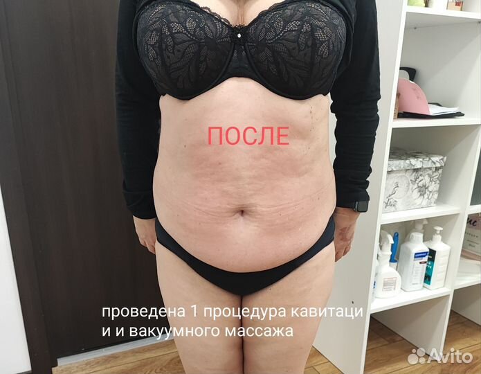 Аппаратный вакуумный массаж, кавитация,RFлифтинг