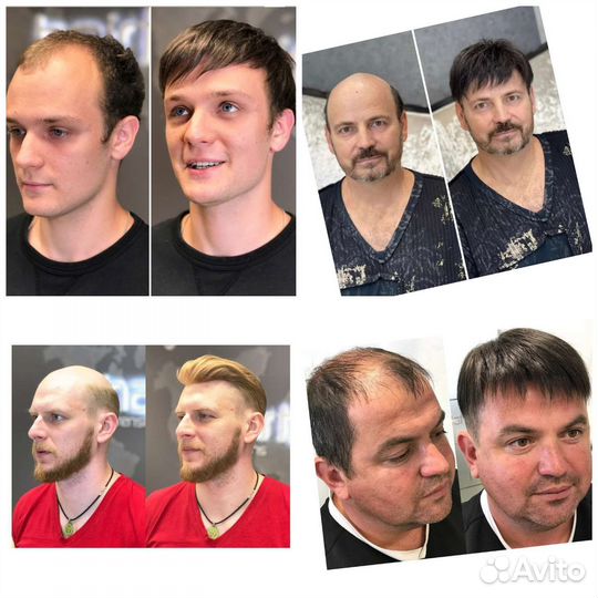 Система замещение для волос