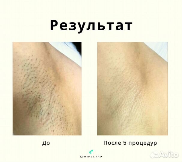 Аппарат для эпиляции Лю'Минес Max’One 1200вт