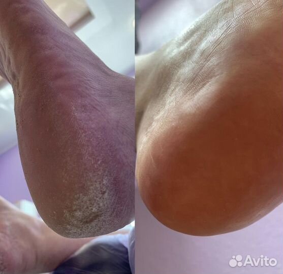 Педикюр