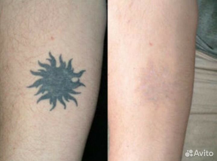 Удаление татуировок татуажа