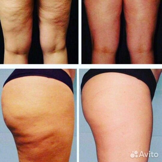 Антицеллюлитный крем