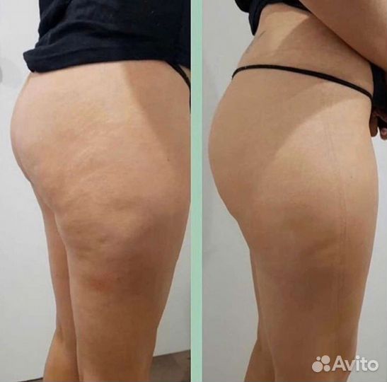 Антицеллюлитный массаж, похудение бразильская попа