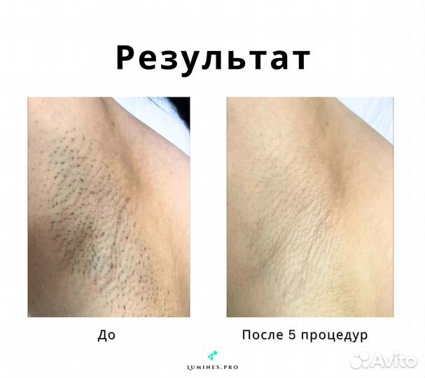 Диодный лазер Lumines’ Макс’Ван 1200в