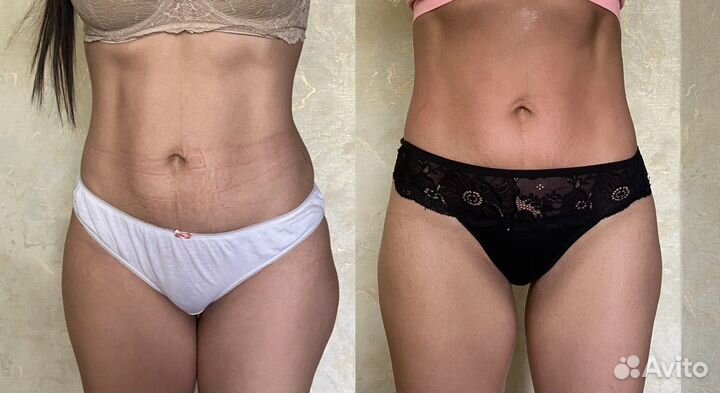 Антицеллюлитный массаж Аппаратный массаж