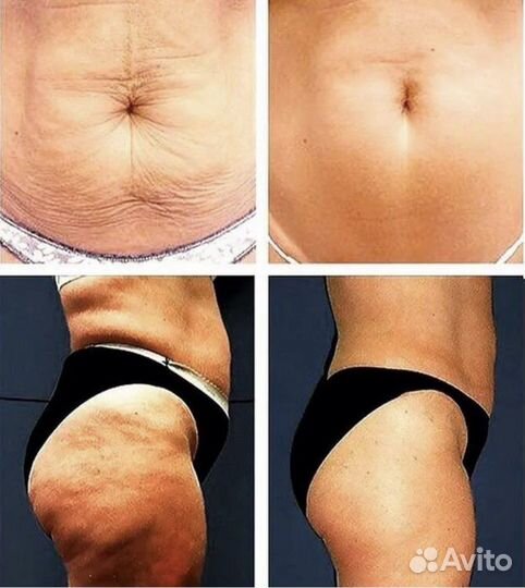 LPG массаж, кавитация, РФ лифтинг лица и тела