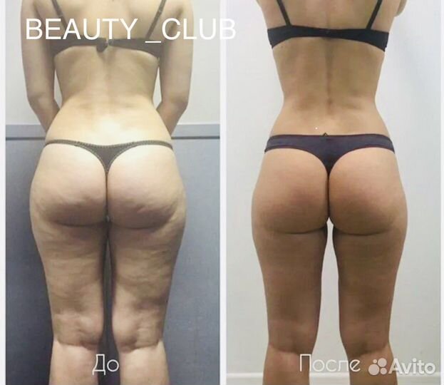 Антицелюлитный Массаж New на аппарате Turbo G 8