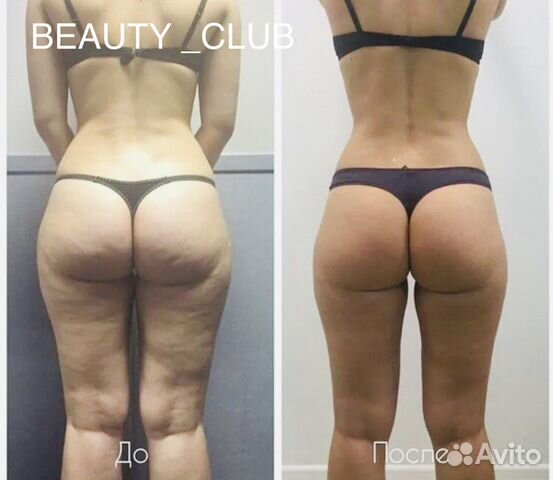 Антицелюлитный Массаж New на аппарате Turbo G 8