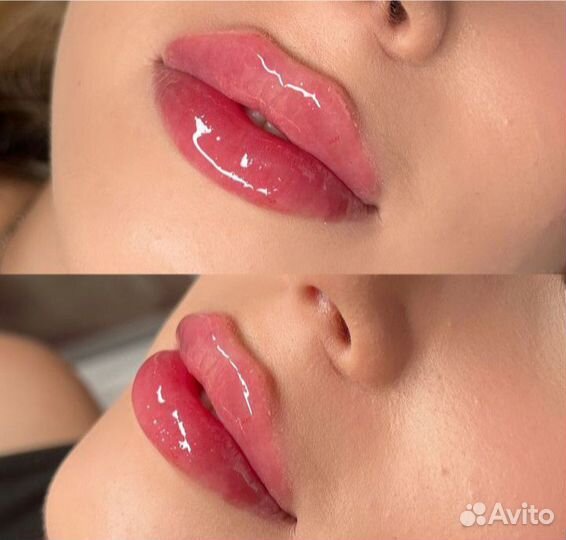 Увеличение губ