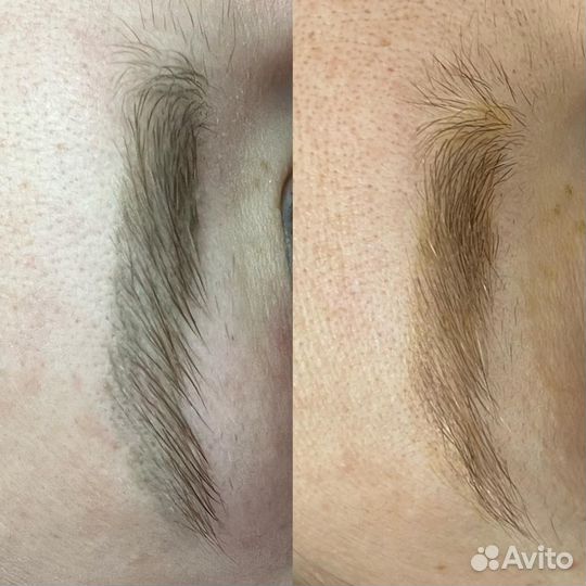 Удаление татуажа лазером