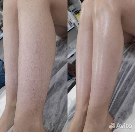 Эпиляция шугаринг