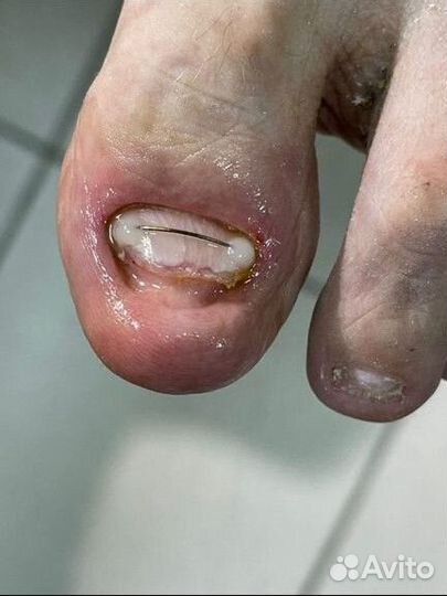 Подолог,медицинский педикюр, SMART педикюр