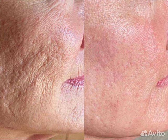 Холодная плазма в режиме лайт