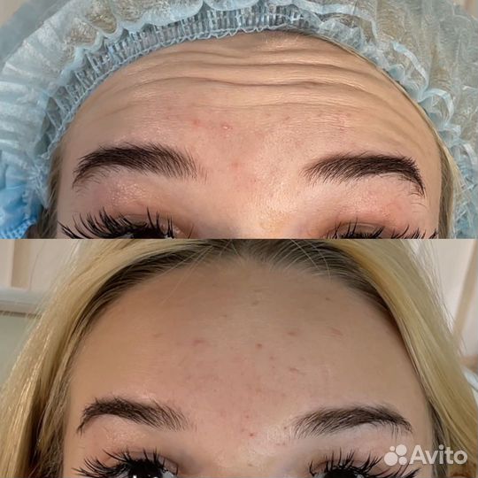 Ботокс для лица