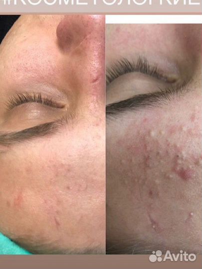 Чистка Лица/Татуаж бровей