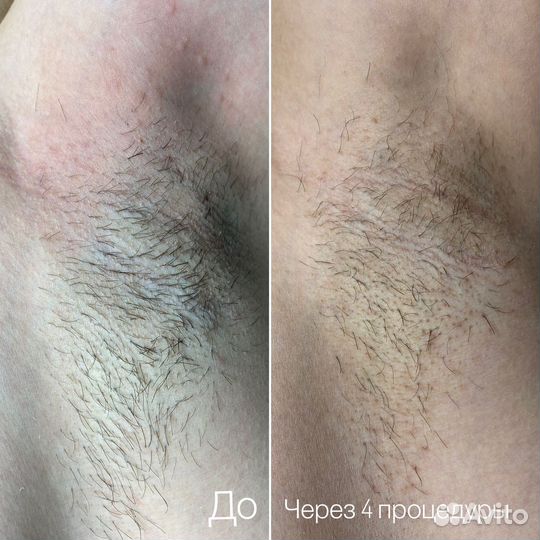 Электроэпиляция