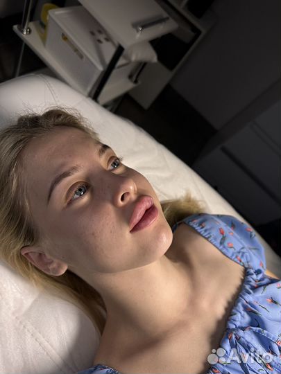 Увелечение губ скул подбородок