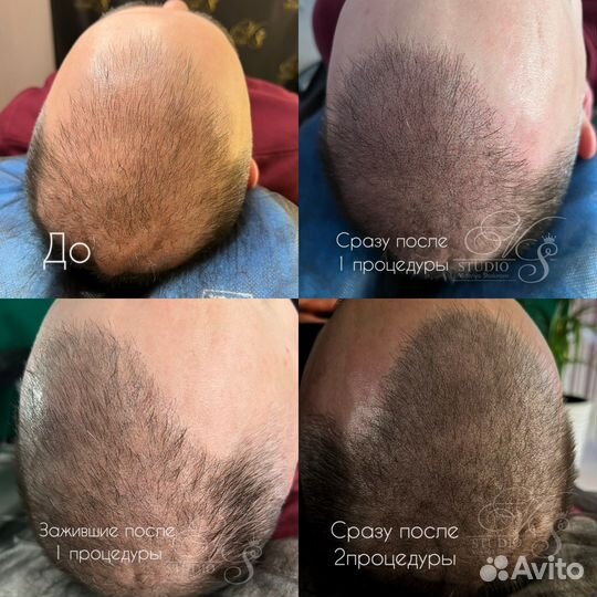 Трихопигментация SMP головы