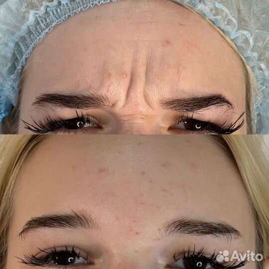 Ботокс для лица