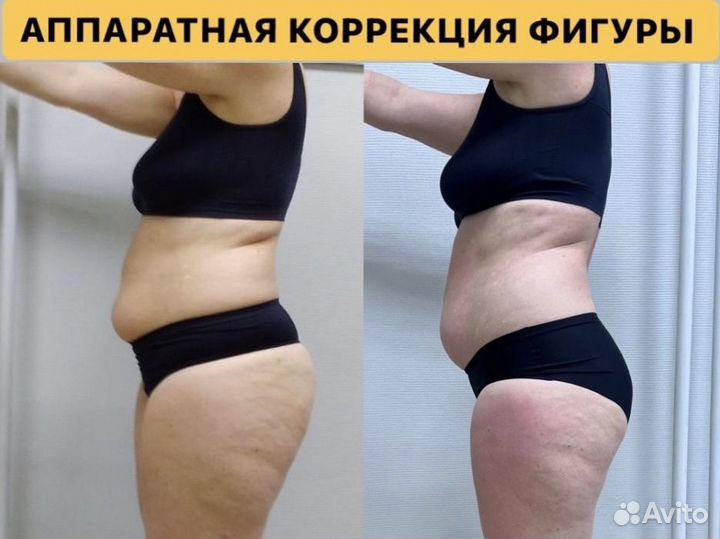 Аппаратное похудение