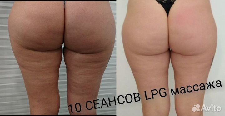 LPG тела и лица спб