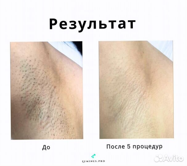 Диодный лазер для эпиляции люминес Макс-Ван 1200 Вт