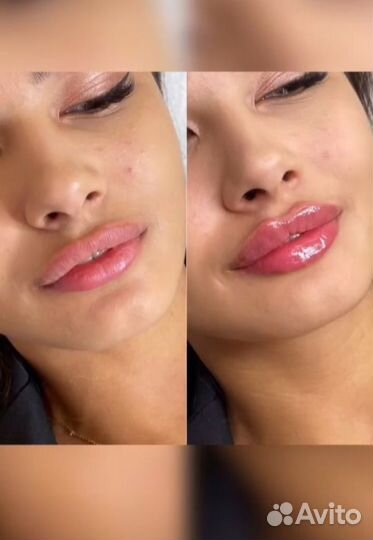 Увеличение губ