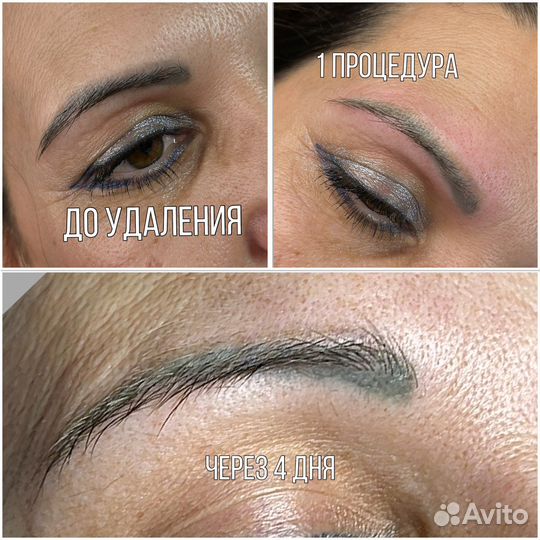 Удаление тату/ татуажа/карбоновый пилинг