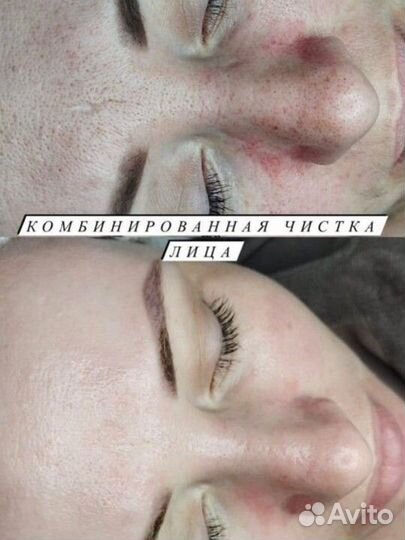 Чистка лица