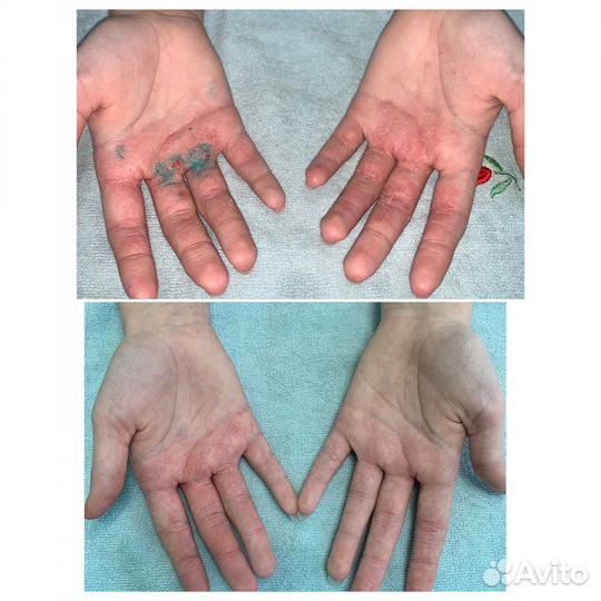 Холодная плазма + обучение