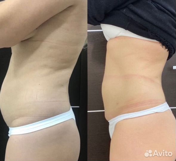 Кавитация коррекция фигуры