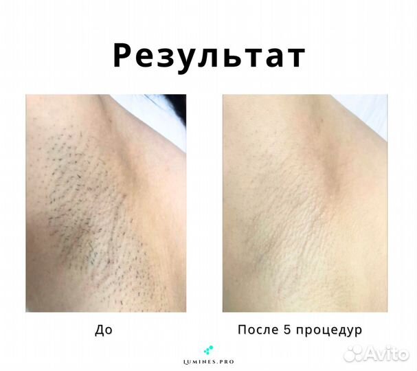 Аппарат для эпиляции Люминес’ Макс-Ван 1200вт