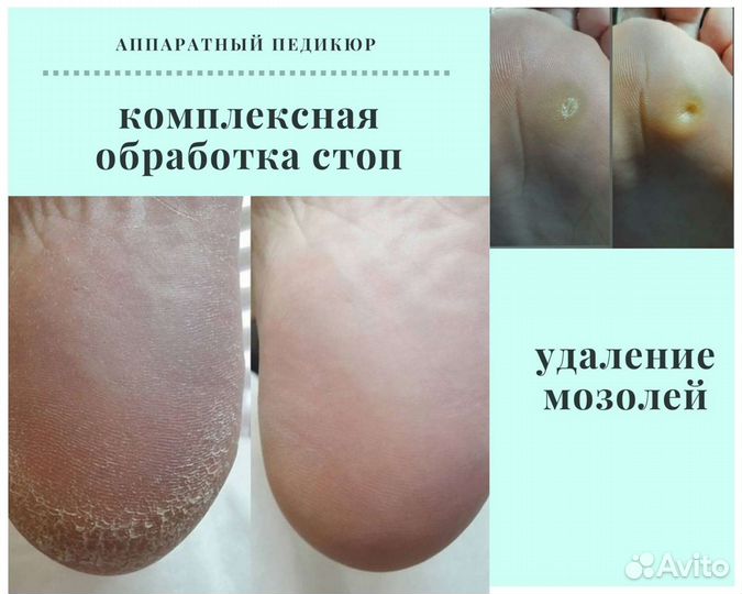 Педикюр. Подолог