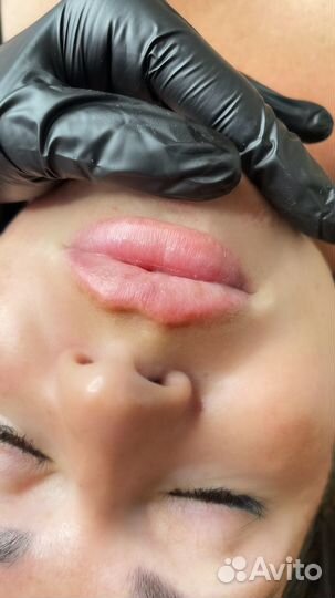 Увеличение губ