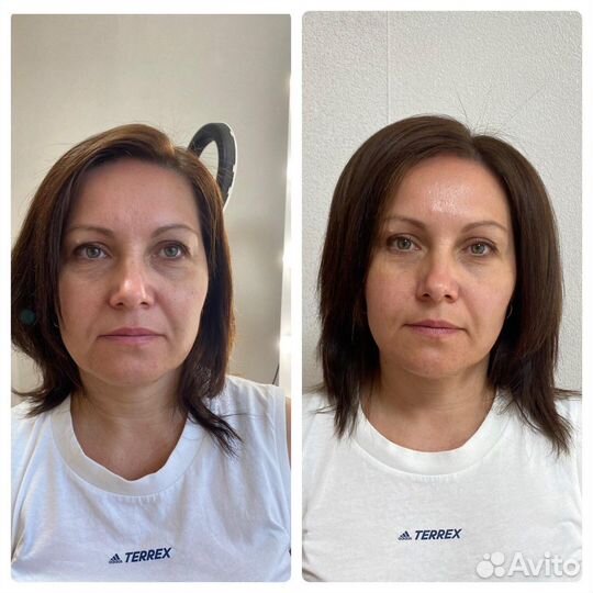 Мк по прикорневому обьему