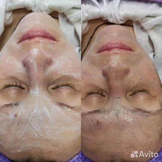 Процедура Фарфоровая куколка