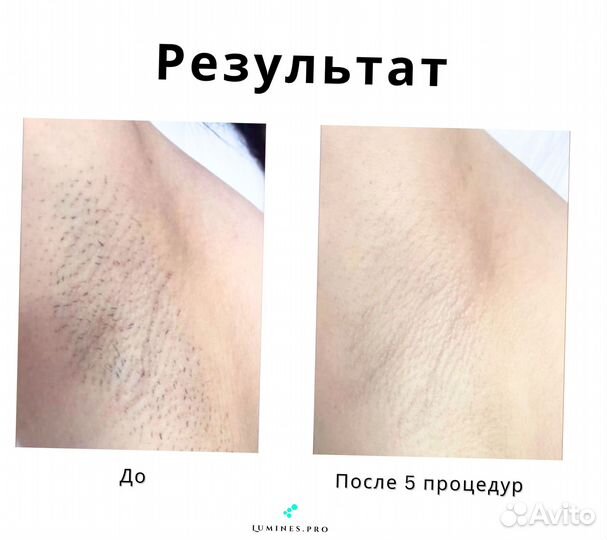 Диодный лазер для эпиляции люминес Макс’Ван 1200 Вт