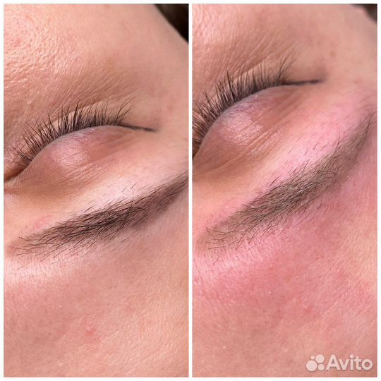 Неодимовый лазер LA15 Nd:YAG