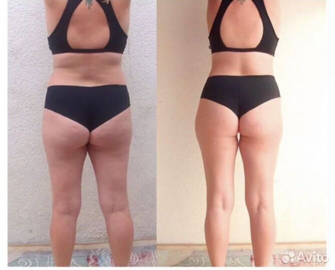 Прессотерапия