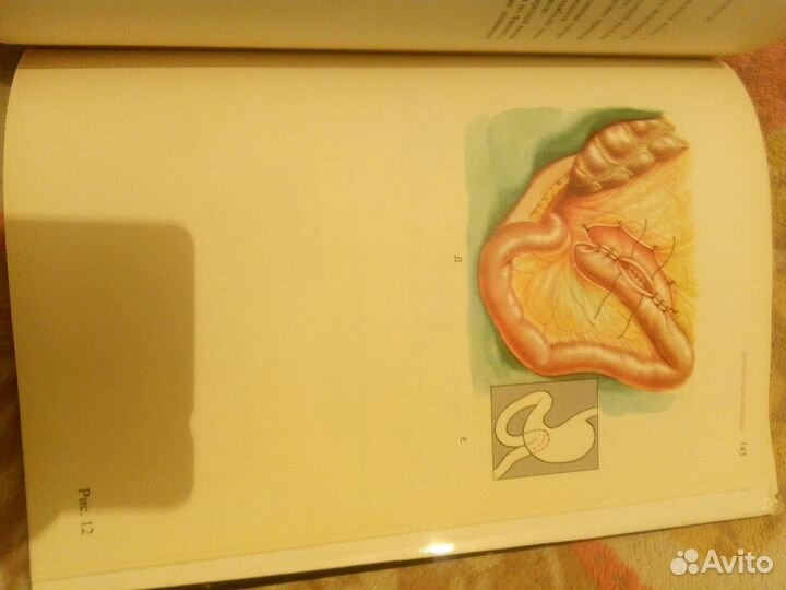 Ваготамия.Трахео -Бронхиальная хирургия