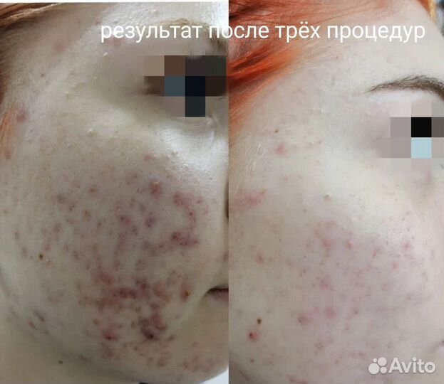 Аппаратная косметология холодная плазма