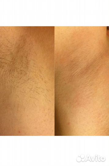 Шугаринг депиляция