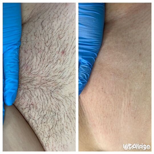 Шугаринг: глубокое бикини