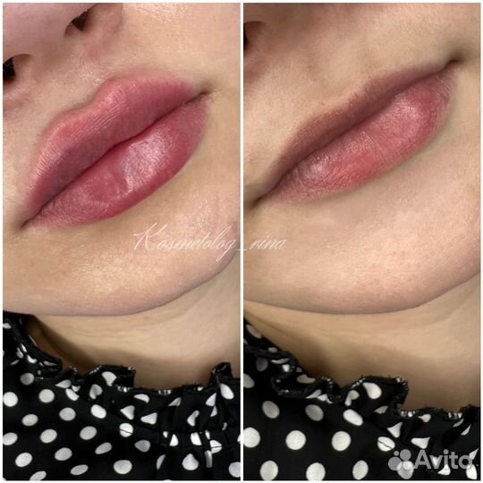 Контурная пластика,увеличение губ,ботокс