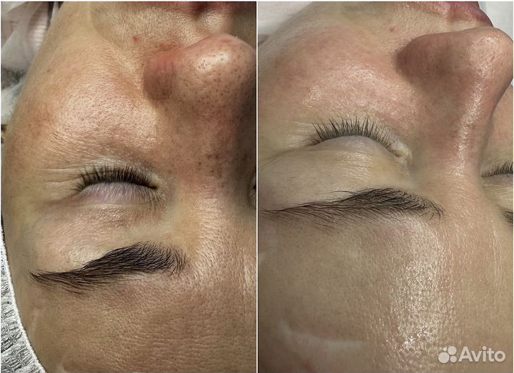 Чистка лица